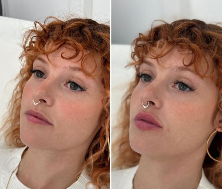 botox em lisboa