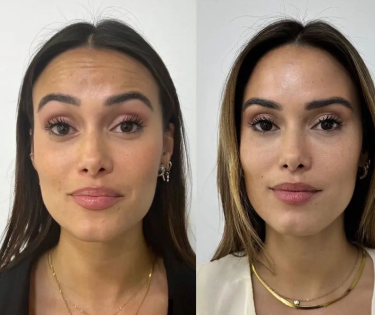 botox em lisboa
