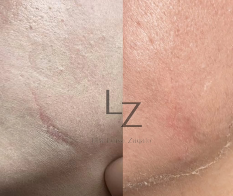 mesoterapia